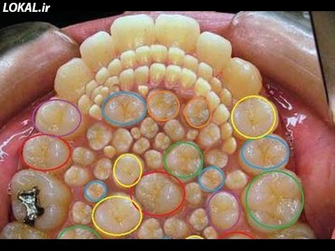 سندرم هایپردونتیا یا دندان زیاد - نادرترین و عجیب ترین بیماری ها